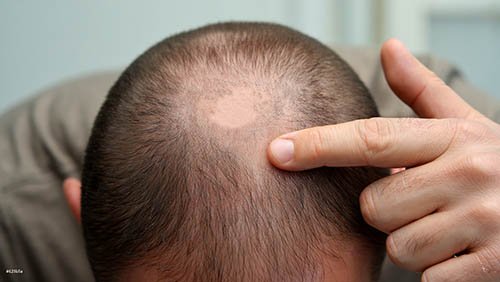 Мужчина указывает на участок облысения